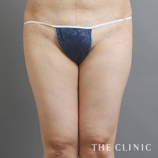【THE CLINIC 症例画像】No.1044_2_太もも_360脂肪吸引®