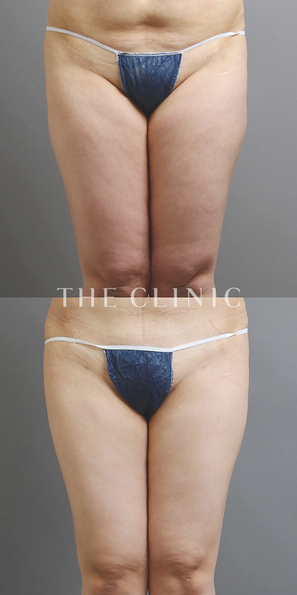 太もものベイザー脂肪吸引（28歳女性）の術前・術後写真