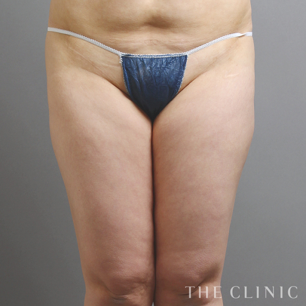 太もものベイザー脂肪吸引（28歳女性）の術前写真