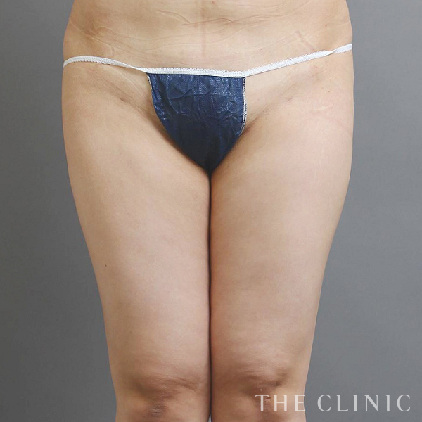 太もものベイザー脂肪吸引（28歳女性）の術後写真