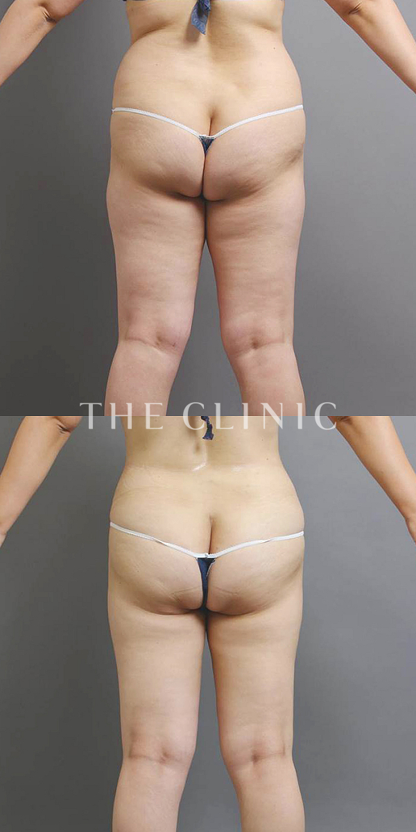 お尻のベイザー脂肪吸引（28歳女性）の術前・術後写真