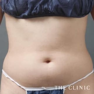 TWOPACK 陰影ある腹部の4D脂肪吸引(4Dリポ)のモニター(30代)術前症例画像