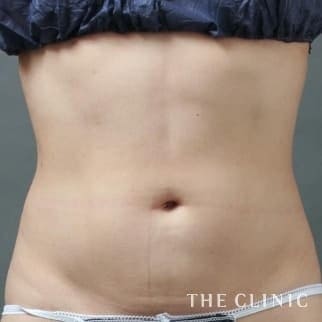 TWOPACK 陰影ある腹部の4D脂肪吸引(4Dリポ)のモニター（30代）術後症例画像