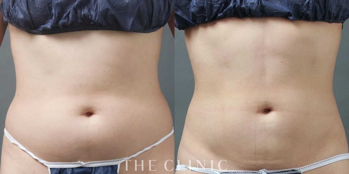 4D脂肪吸引(4Dリポ)の術前/術後