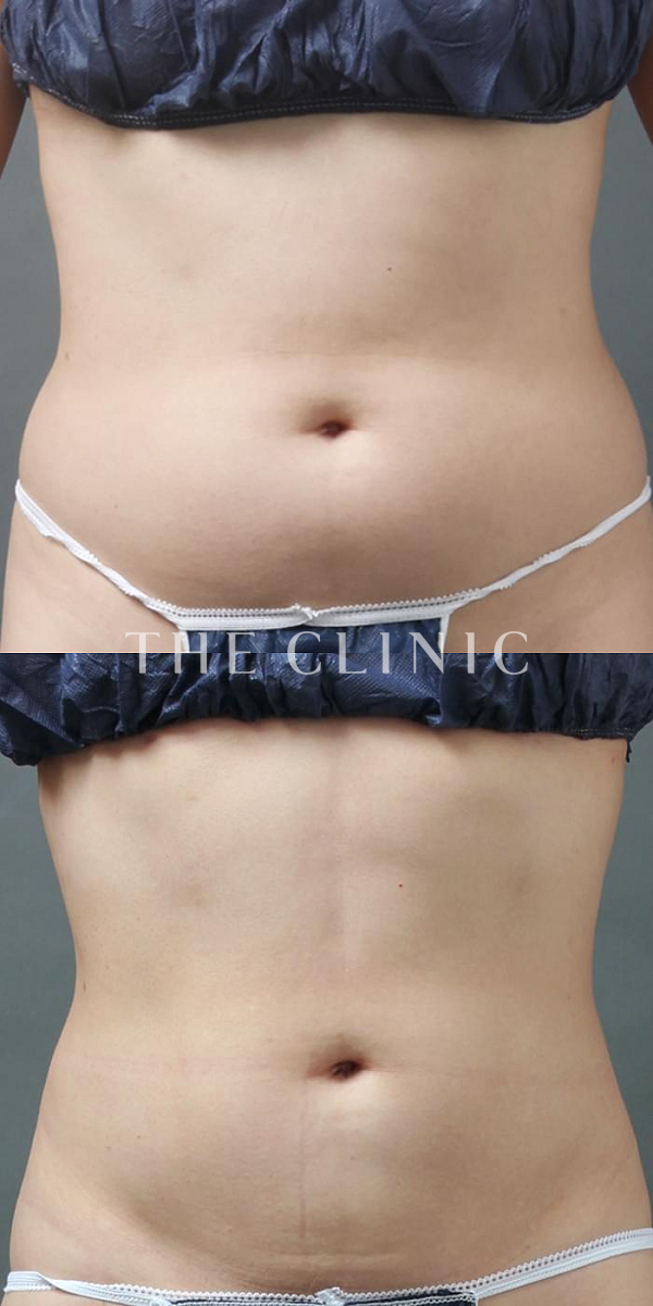 TWOPACK 陰影ある腹部の4D脂肪吸引(4Dリポ)（36歳女性）の術前・術後写真