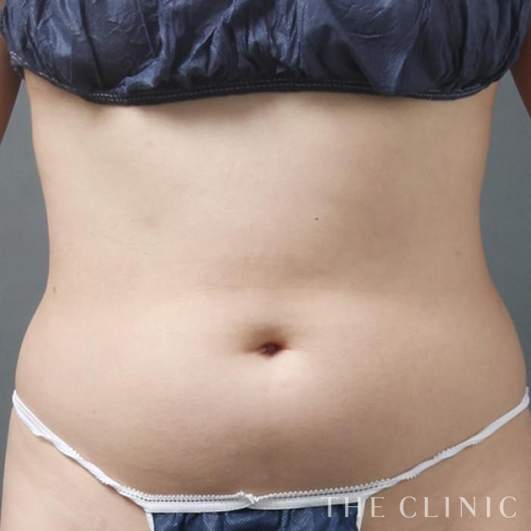 TWOPACK 陰影ある腹部の4D脂肪吸引(4Dリポ)（36歳女性）の術前写真