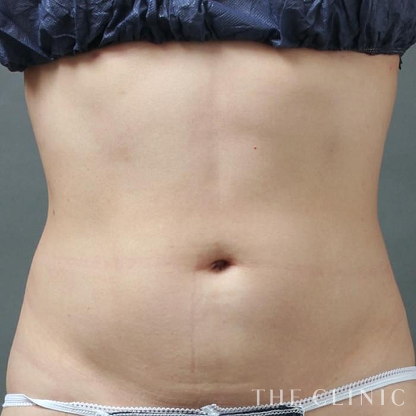 TWOPACK 陰影ある腹部の4D脂肪吸引(4Dリポ)（36歳女性）の術後写真