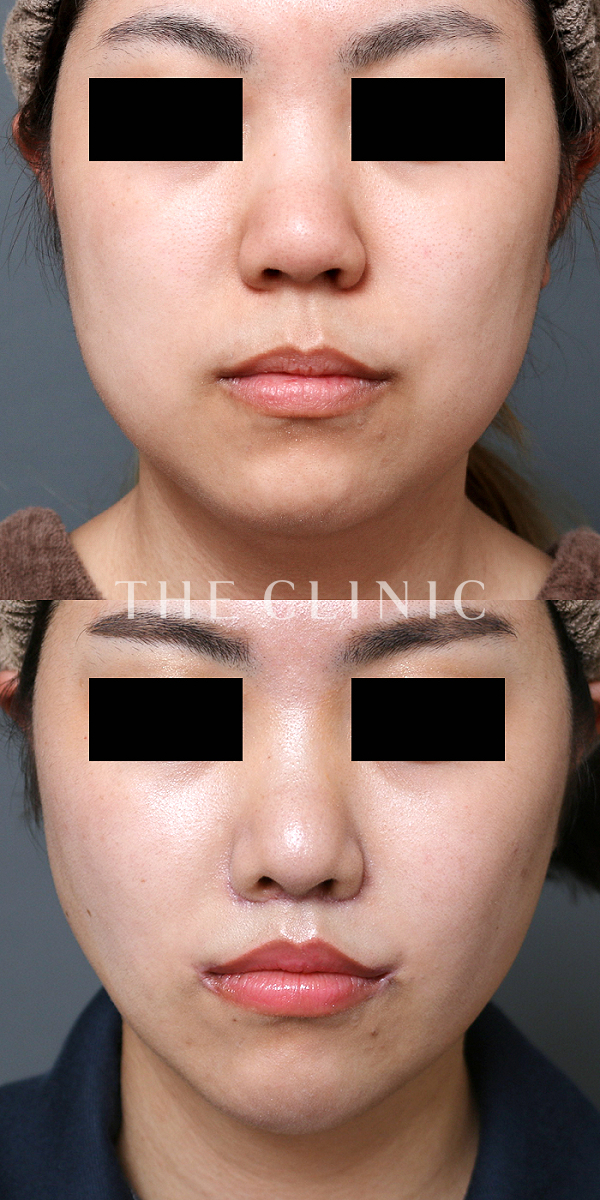 頰／顎のベイザー脂肪吸引（31歳女性）の術前・術後写真