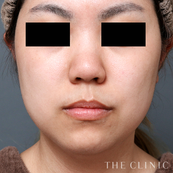 頰／顎のベイザー脂肪吸引（31歳女性）の術前写真