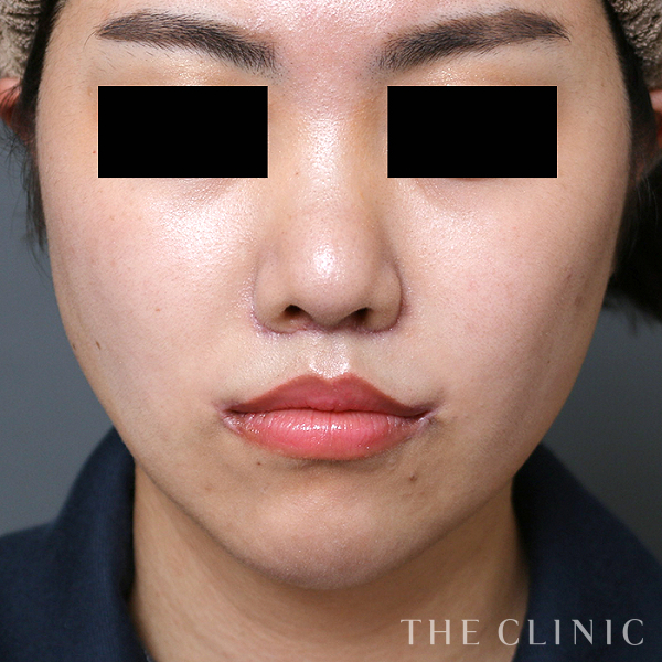 頰／顎のベイザー脂肪吸引（31歳女性）の術後写真