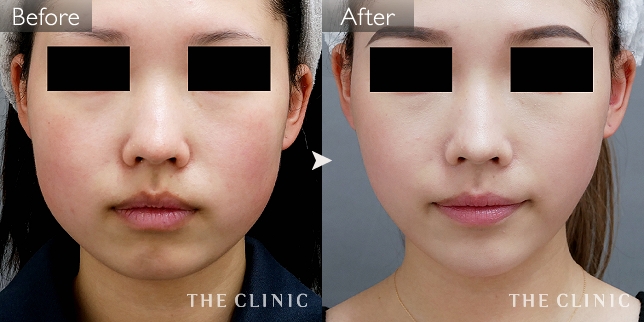 エイジング治療 頰／顎 症例写真