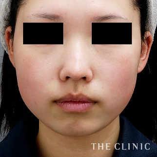 【THE CLINIC 症例画像】No.1066_1_頰/顎_ベイザー脂肪吸引
