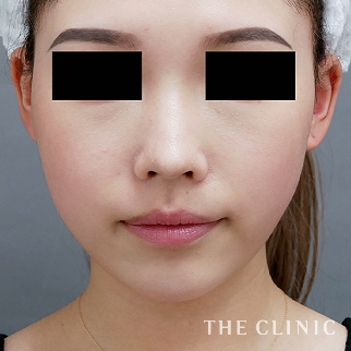【THE CLINIC 症例画像】No.1066_2_頰/顎_360脂肪吸引®