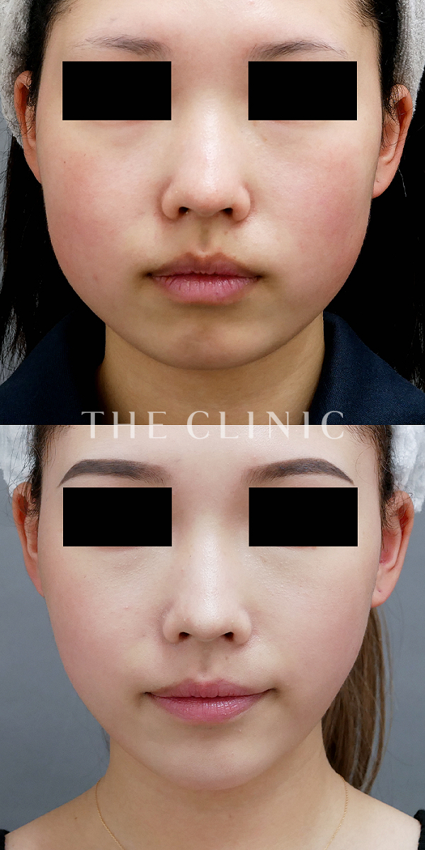 頰／顎のベイザー脂肪吸引（23歳女性）の術前・術後写真