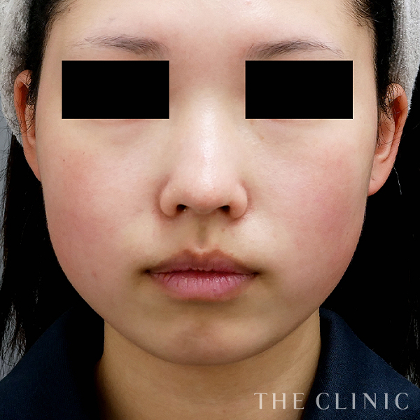 頰／顎のベイザー脂肪吸引（23歳女性）の術前写真