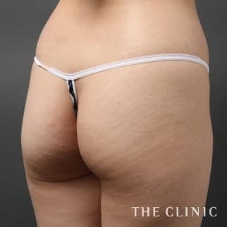 【THE CLINIC 症例画像】No.106_1_ヒップアップ_4D脂肪吸引(4Dリポ)(執刀医:)
