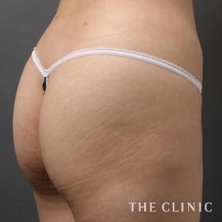 【THE CLINIC 症例画像】No.106_2_ヒップアップ_4D脂肪吸引(4Dリポ)(執刀医:)