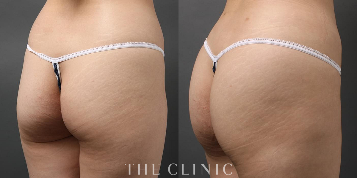 4D脂肪吸引(4Dリポ)の術前/術後