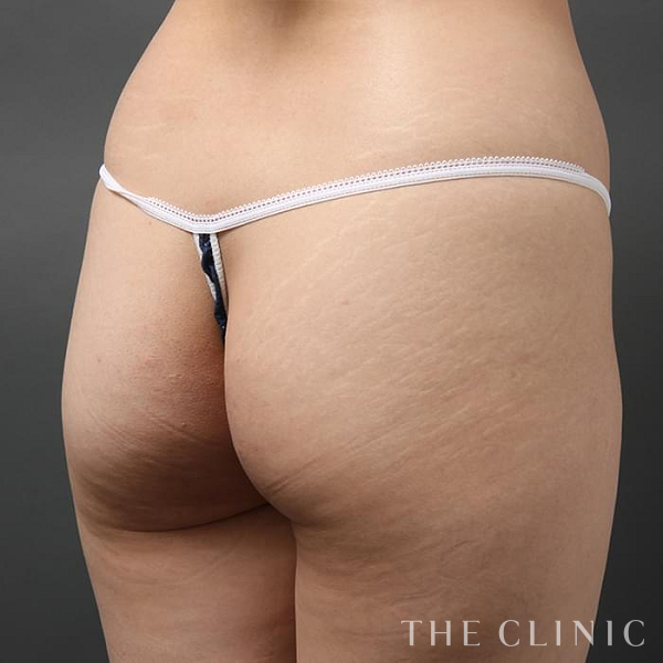 ヒップアップの4D脂肪吸引(4Dリポ)（29歳女性）の術前写真