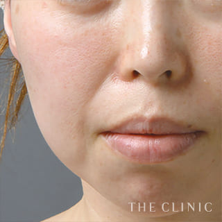 【THE CLINIC 症例画像】No.107_1_法令線_マイクロCRF注入(顔の脂肪注入)