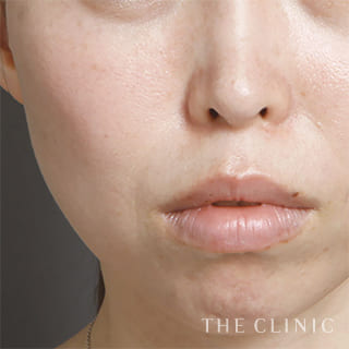 【THE CLINIC 症例画像】No.107_2_法令線_マイクロCRF注入(顔の脂肪注入)