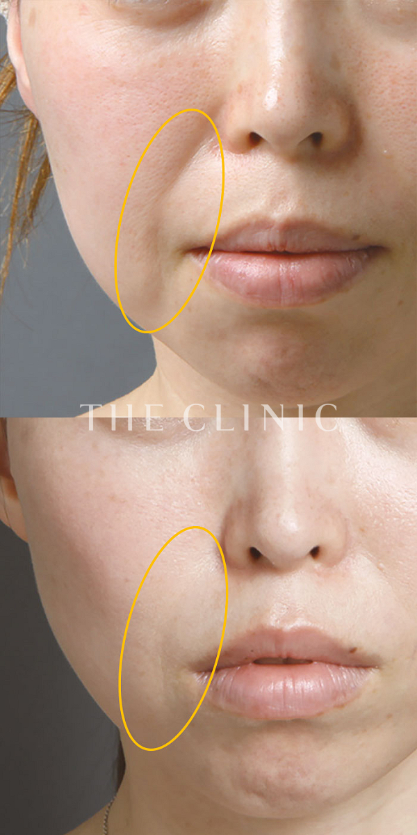 法令線のマイクロCRF注入(顔の脂肪注入)（40歳女性）の術前・術後写真