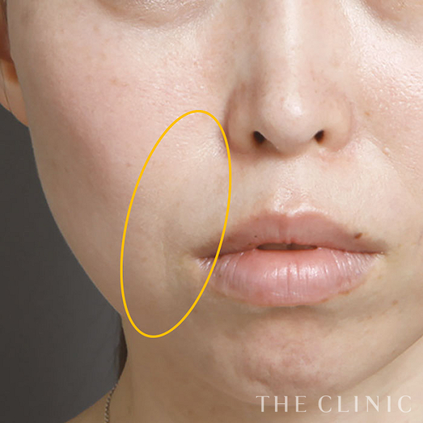 法令線のマイクロCRF注入(顔の脂肪注入)（40歳女性）の術後写真