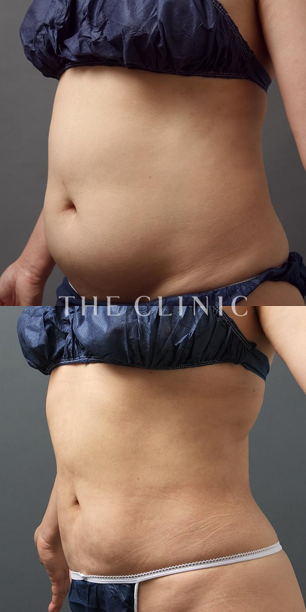 腹部のベイザー脂肪吸引（48歳女性）の術前・術後写真