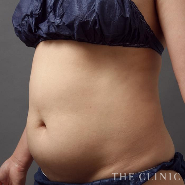 腹部のベイザー脂肪吸引（48歳女性）の術前写真