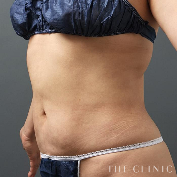 腹部のベイザー脂肪吸引（48歳女性）の術後写真