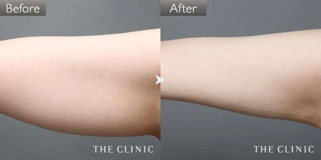 二の腕(女性/29歳)