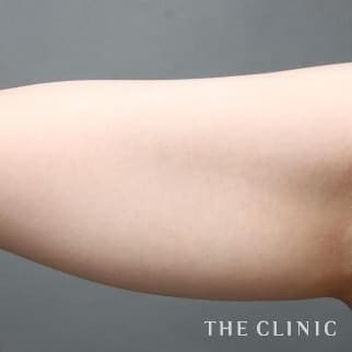【THE CLINIC 症例画像】No.111_1_二の腕_360脂肪吸引®