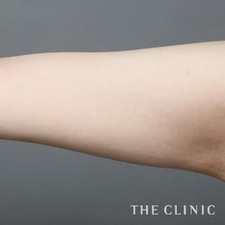 【THE CLINIC 症例画像】No.111_2_二の腕_360脂肪吸引®