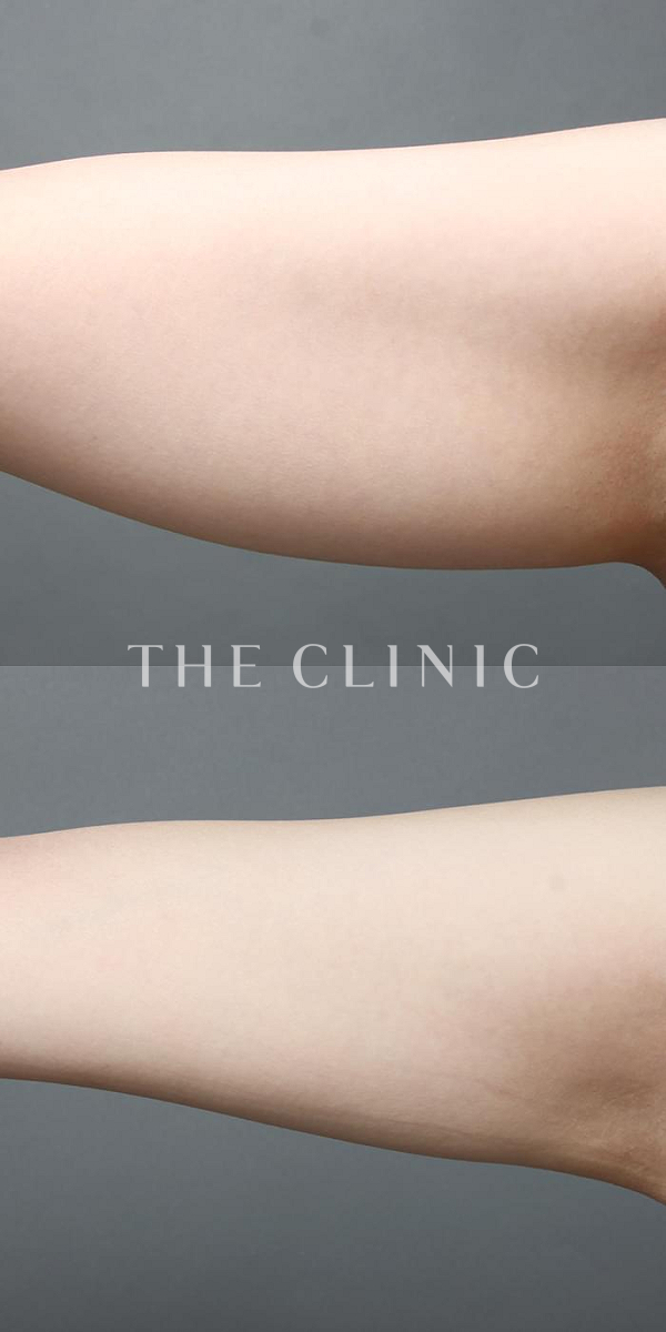 二の腕のベイザー脂肪吸引（29歳女性）の術前・術後写真