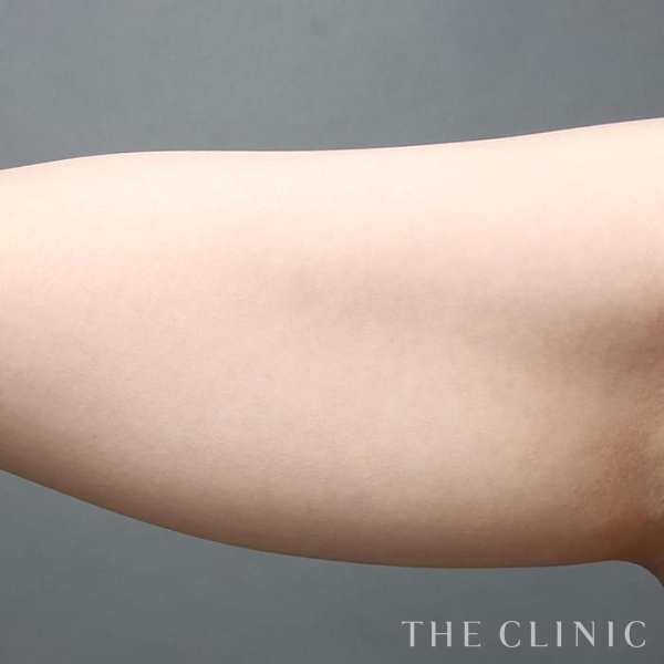 二の腕のベイザー脂肪吸引（29歳女性）の術前写真