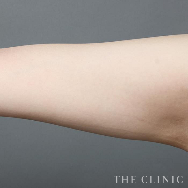 二の腕のベイザー脂肪吸引（29歳女性）の術後写真
