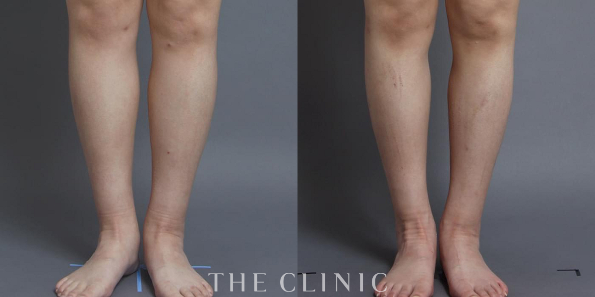 ふくらはぎの360脂肪吸引®（38歳女性）の術前／術後