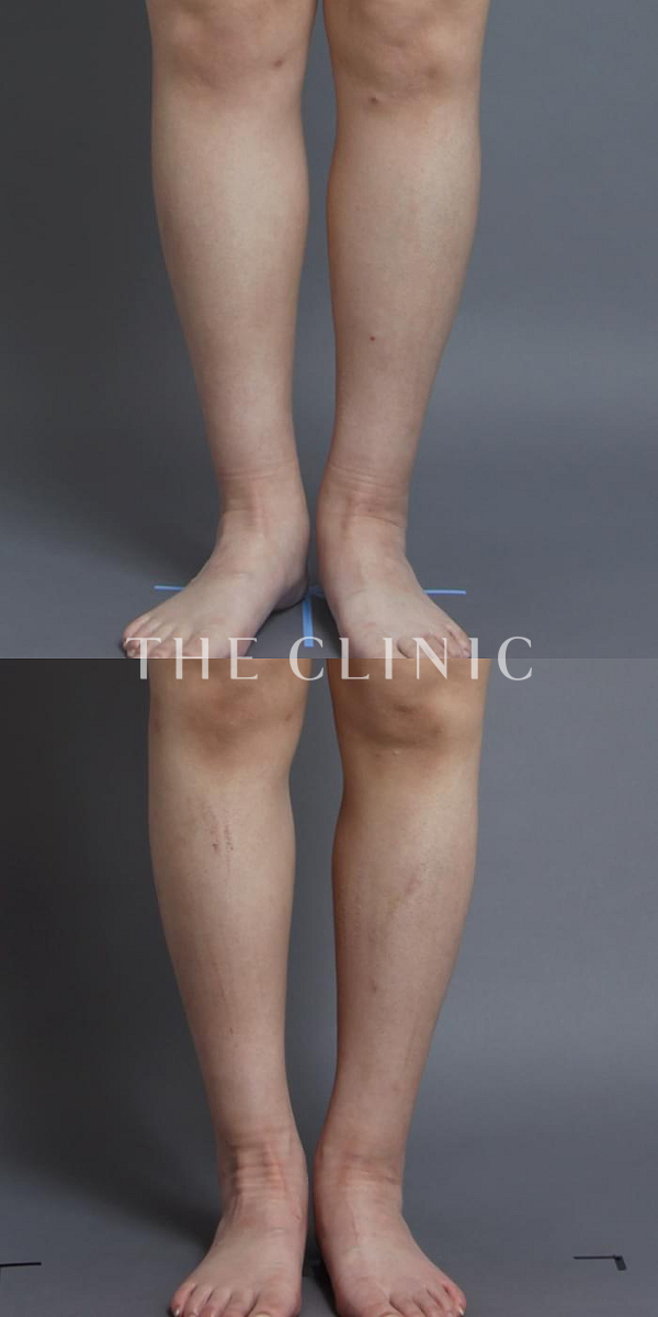 ふくらはぎの360脂肪吸引®（38歳女性）の術前・術後写真
