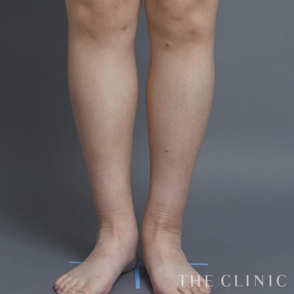 ふくらはぎの360脂肪吸引®（38歳女性）の術前写真