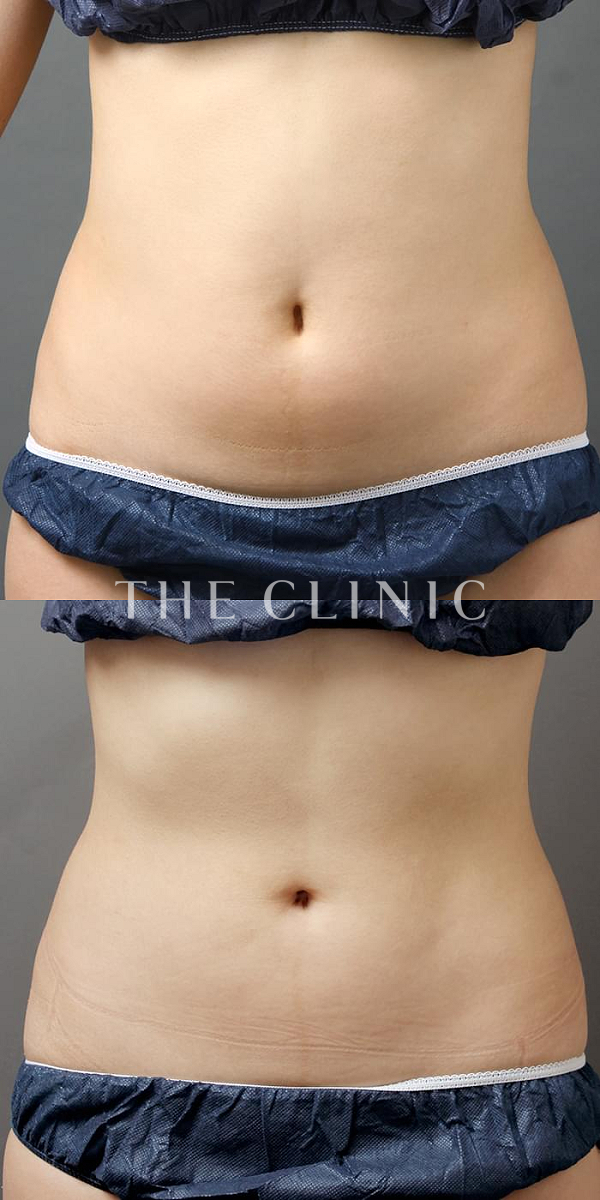 腹部のベイザー脂肪吸引（22歳女性）の術前・術後写真