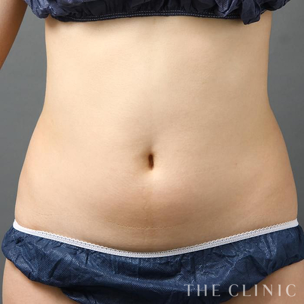 腹部のベイザー脂肪吸引（22歳女性）の術前写真