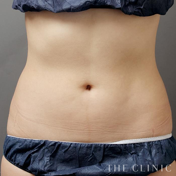 腹部のベイザー脂肪吸引（22歳女性）の術後写真