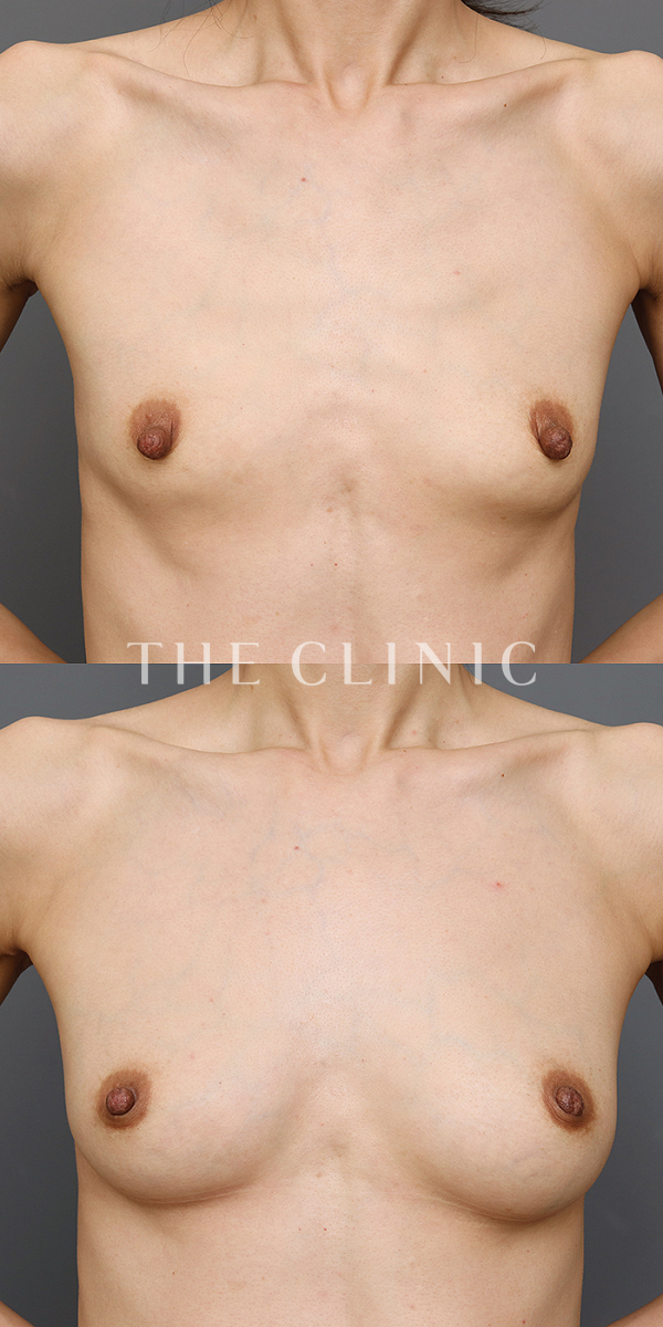 ボリュームアップのエクソソーム豊胸（41歳女性）の術前・術後写真