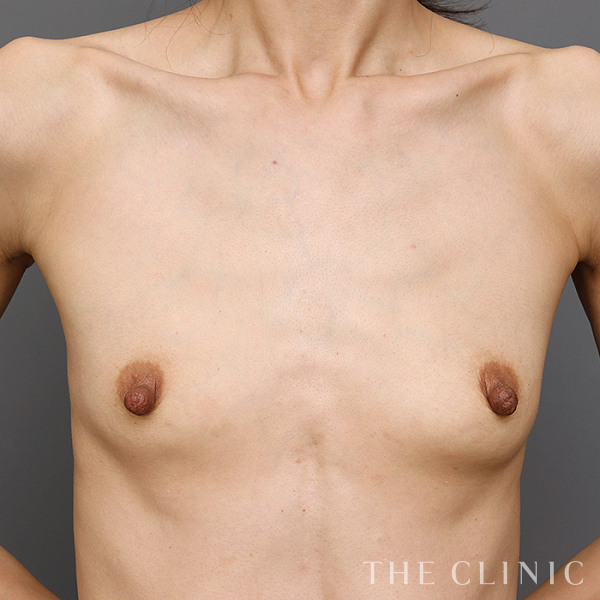 ボリュームアップのエクソソーム豊胸（41歳女性）の術前写真