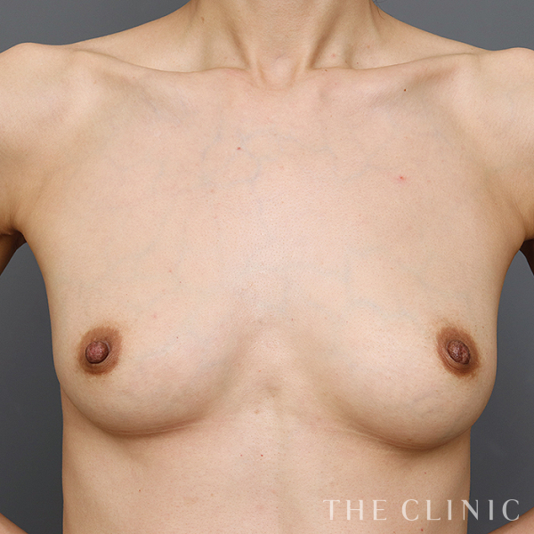 ボリュームアップのエクソソーム豊胸（41歳女性）の術後写真