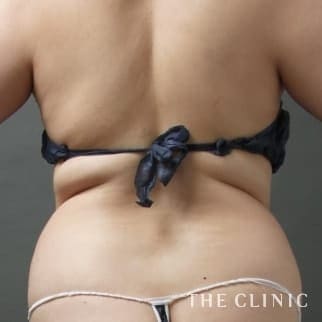 【THE CLINIC 症例画像】No.114_1_背中_360脂肪吸引®