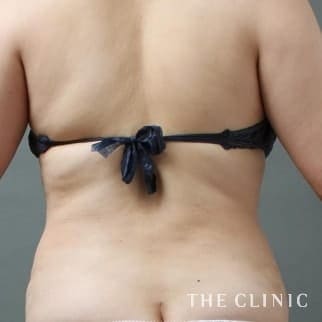 【THE CLINIC 症例画像】No.114_2_背中_360脂肪吸引®