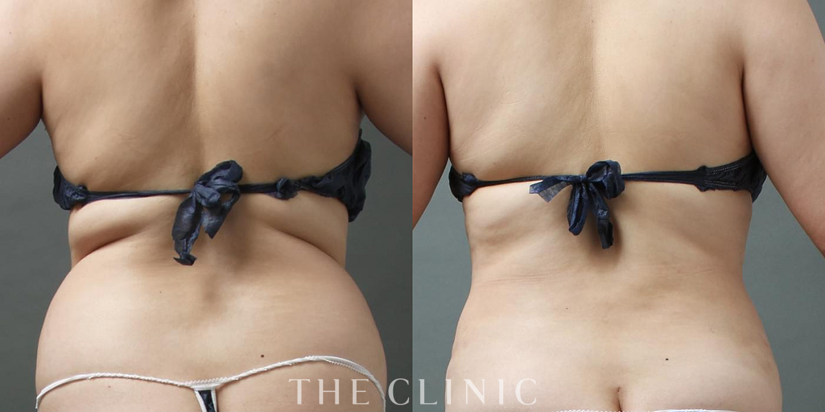 360脂肪吸引®の術前／術後