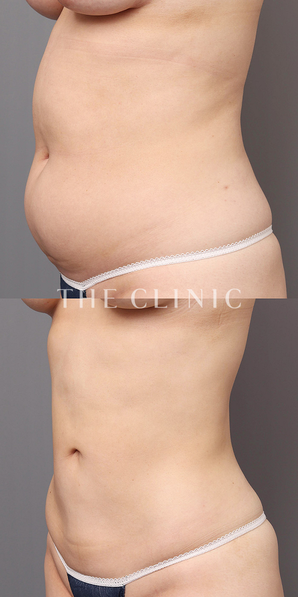 腹部のベイザー脂肪吸引（22歳女性）の術前・術後写真