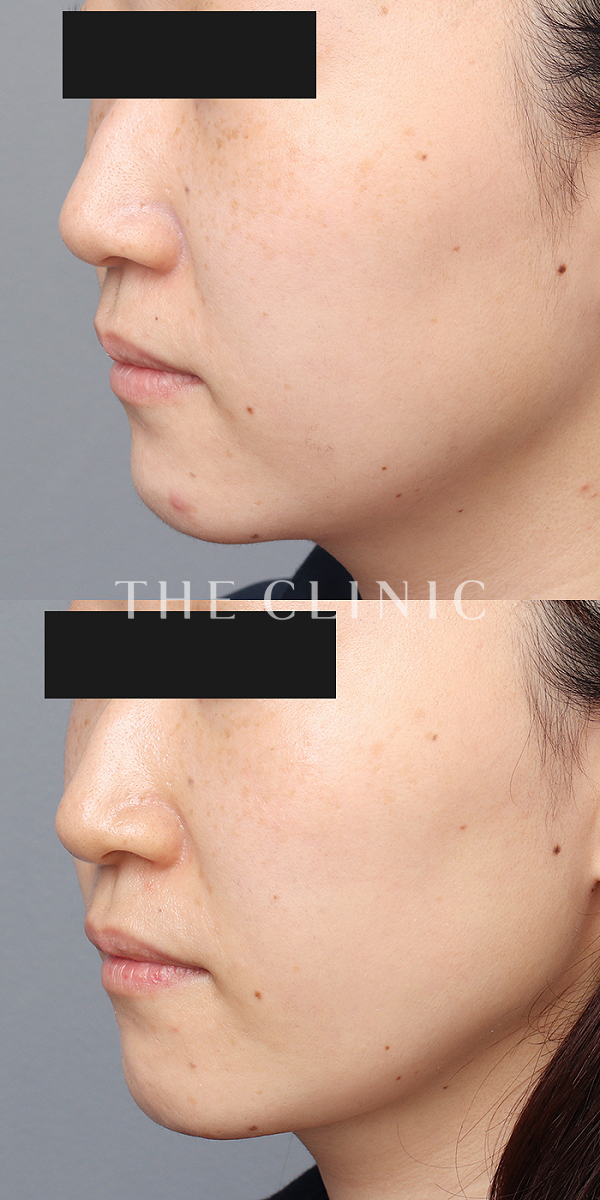 頰／顎のベイザー脂肪吸引（32歳女性）の術前・術後写真